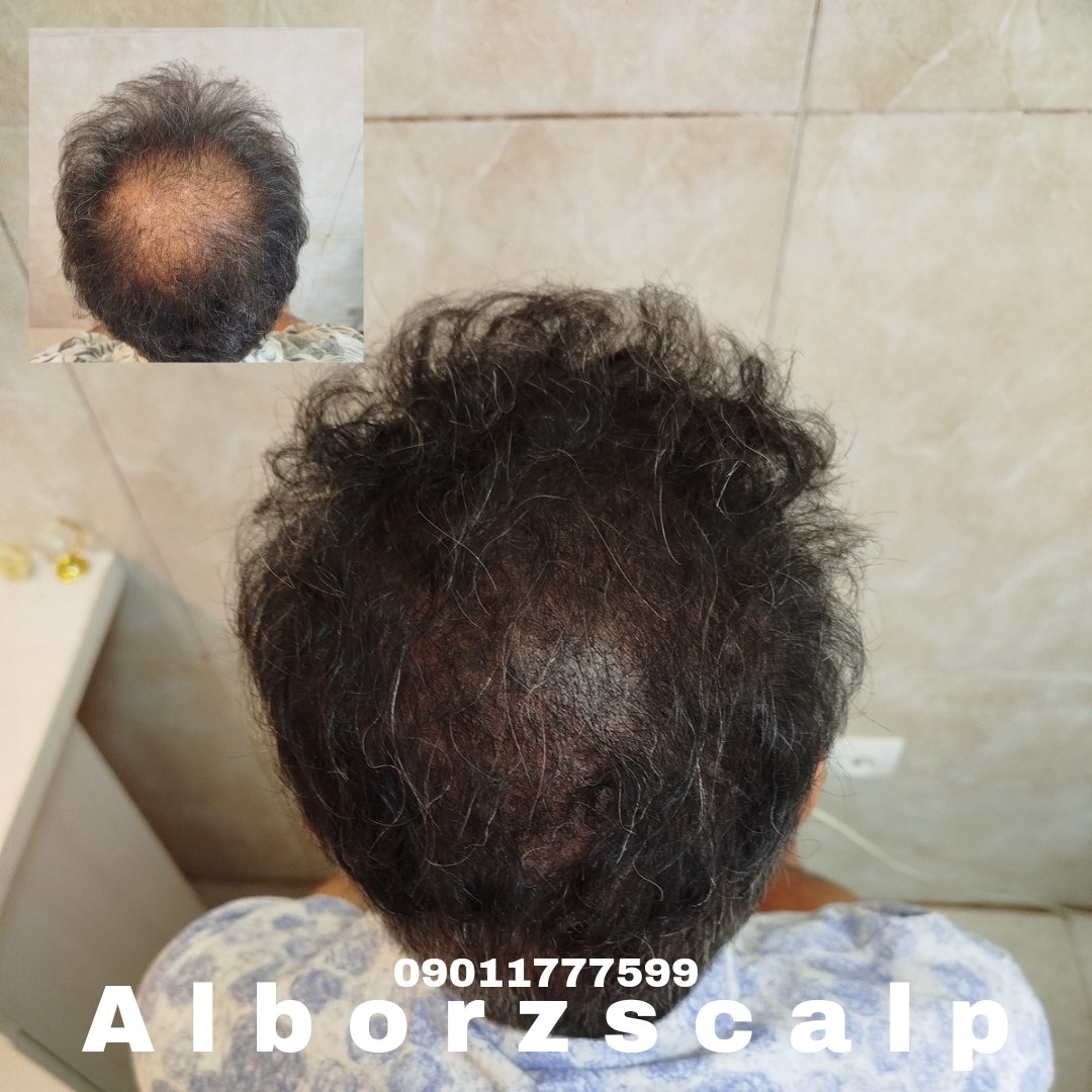 اسکالپ پوششی